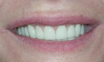 Full mouth restoration after