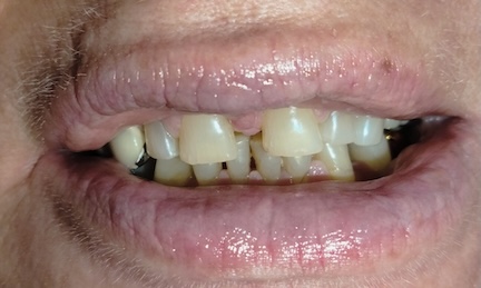 Full mouth restoration before