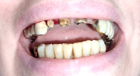Vera before