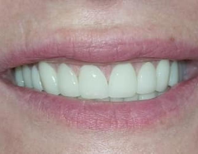 Full mouth restoration after Full mouth restoration after