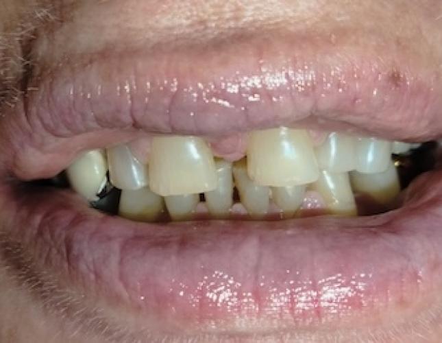 Full mouth restoration before Full mouth restoration before